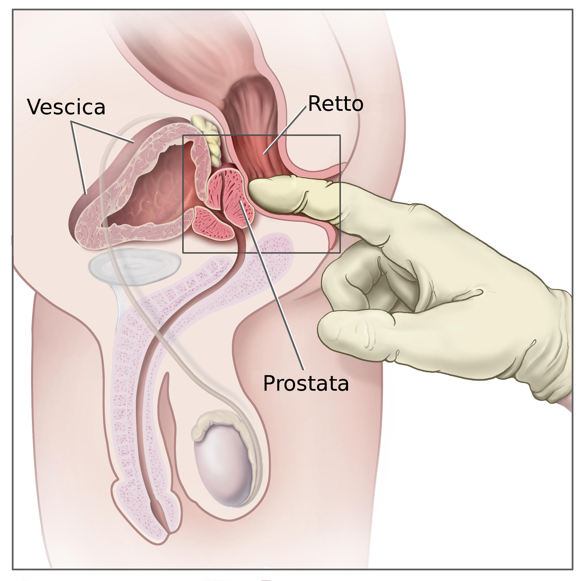 milyen nyomás alatt a prostatitis)